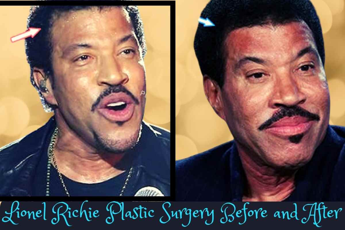 Lionel Richie Plastic Surgery Before and After