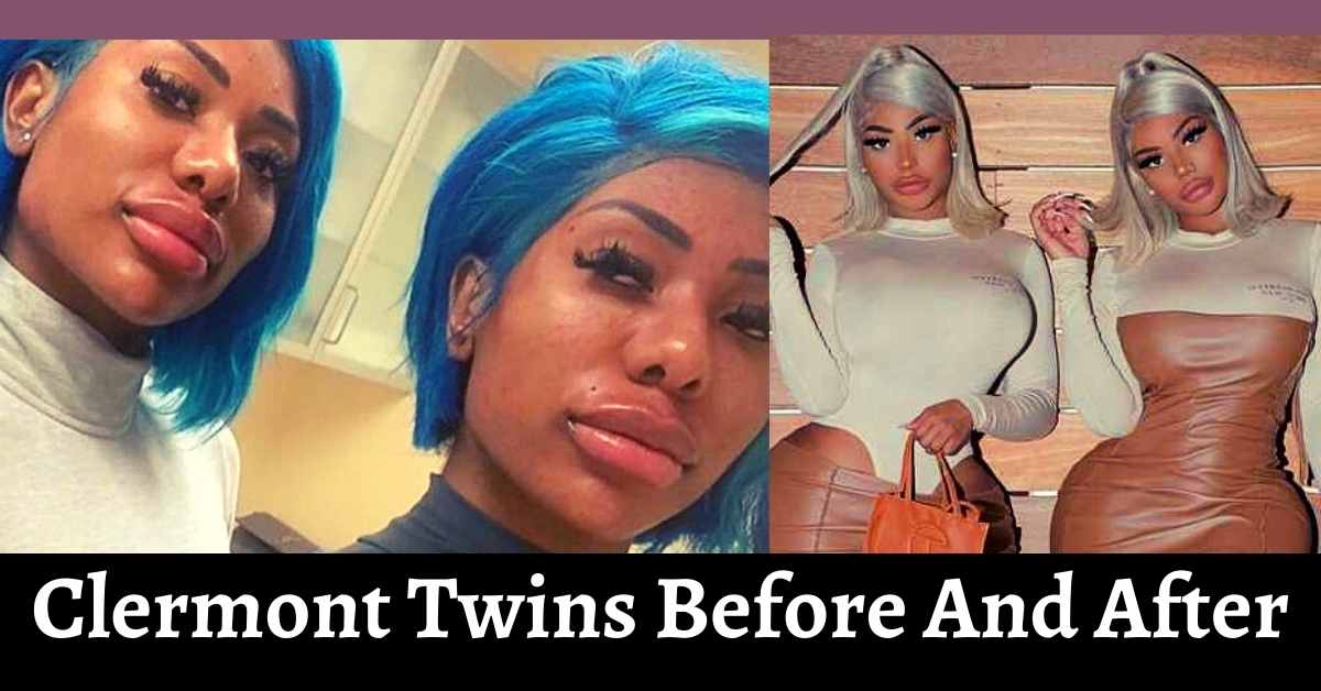 Clermont Twins Before And After 