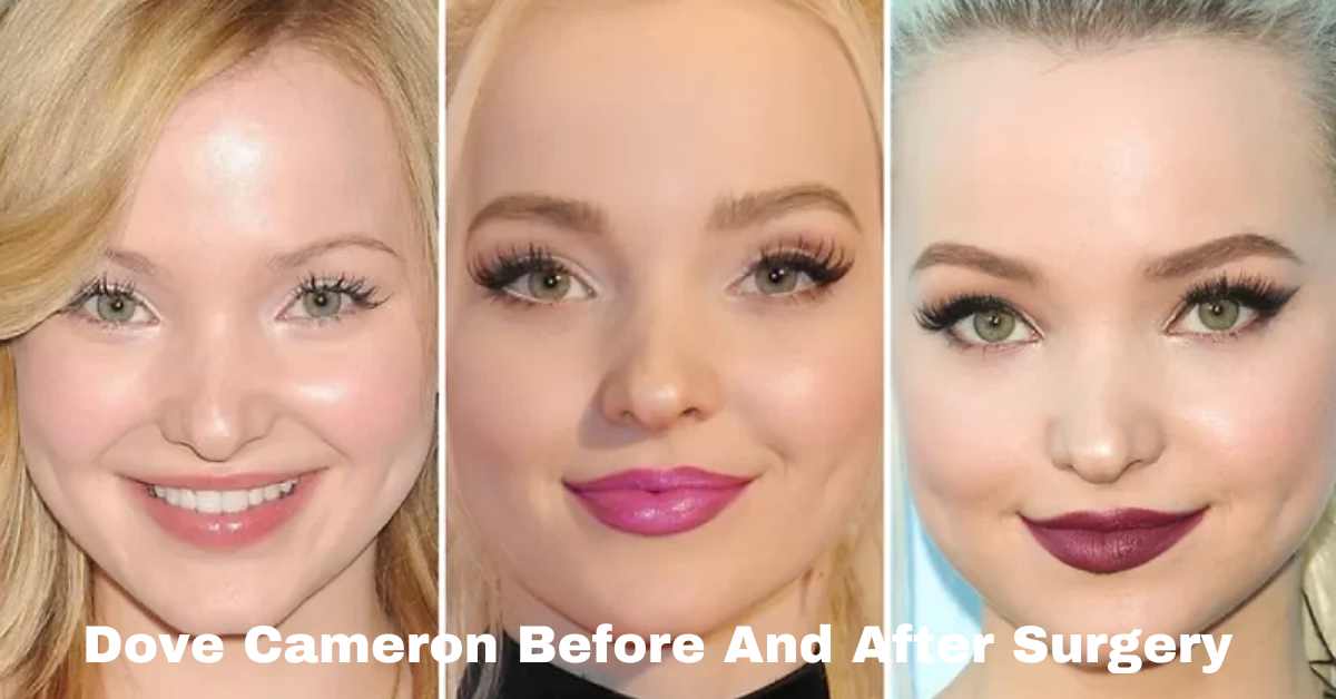 Dove Cameron Before And After Surgery