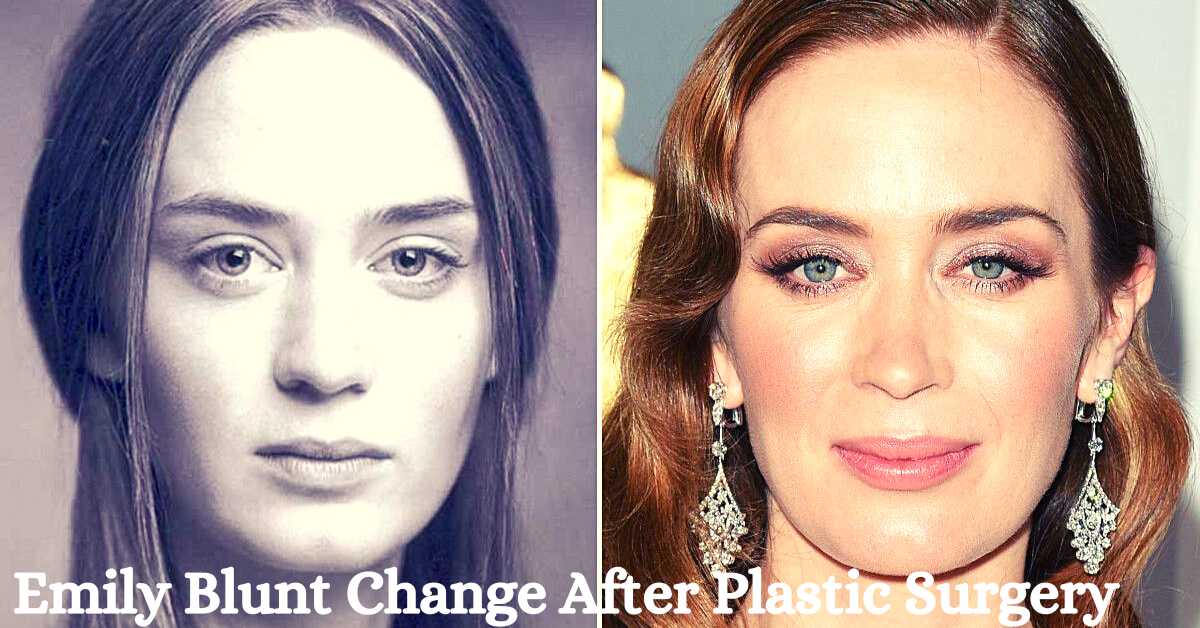 Emily Blunt Change After Plastic Surgery