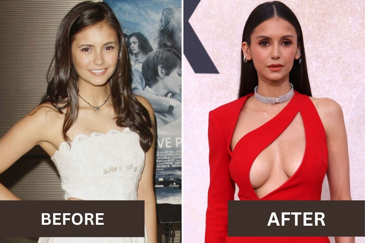 Nina Dobrev Plastic Surgery: Before and After Transformation Details!