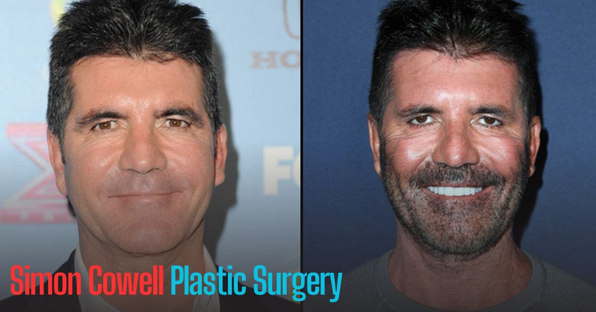 Simon Cowell Plastic Surgery